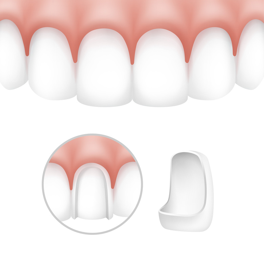 Crowns, Caps, Bridges & Dentures in College Road Nashik