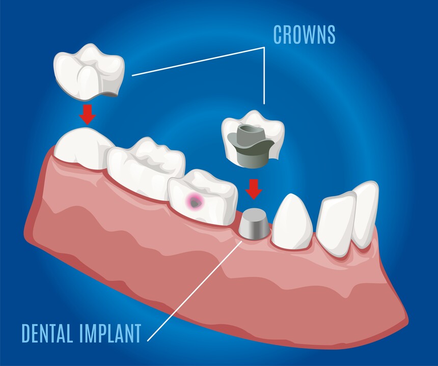 Crowns, Caps, Bridges & Dentures in Gangapur Road, Nashik