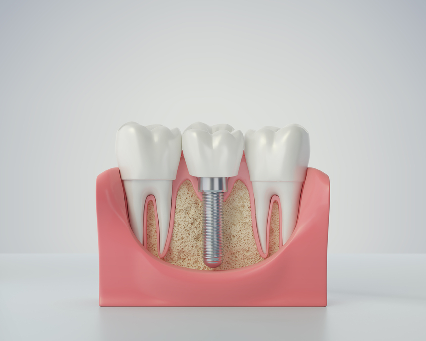 Dental Implant in Canada Corner Nashik | Care32 Dental Clinic