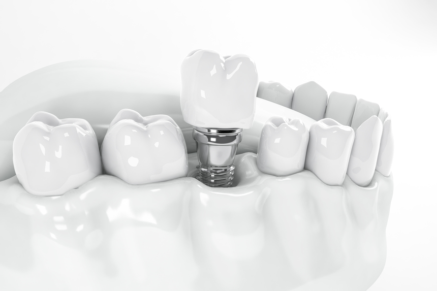 Dental Implant in Gangapur Road Nashik - Dental Experts 