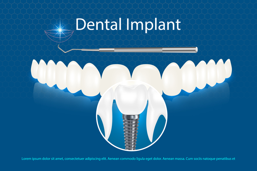 Dental Implant in Mahatma Nagar Nashik