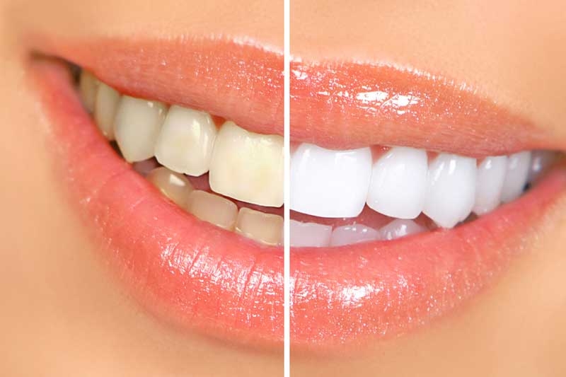 Effective Teeth Whitening Treatments in Nashik Care32 Dental