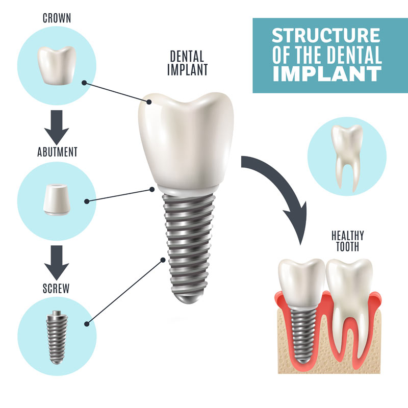 Everything You Need to Know About Dental Implants - Care32 Nashik