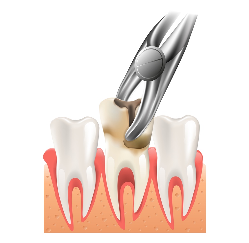 Painless Tooth Extractions in College Road Nashik | Dental Clinic
