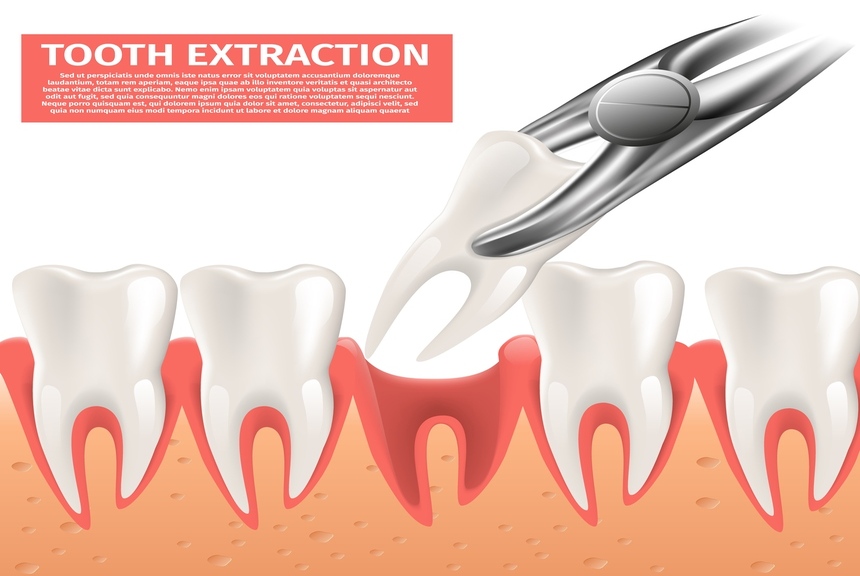 Painless Tooth Extractions in Mahatma Nagar Nashik 