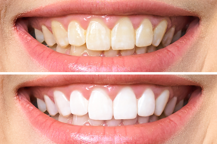 Teeth Whitening in Mahatma Nagar Nashik