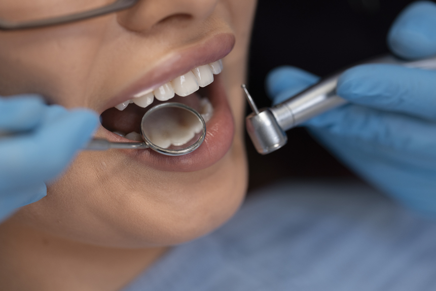 Tooth Color Fillings in College Road Nashik - Dental Clinic